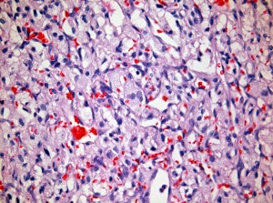 Bone Marrow Hematopoetic After RDO Decalcifier